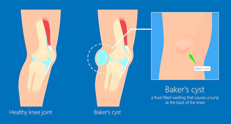 Kyste poplité (kyste de Baker) : découvrez les causes, symptômes, diagnostic et traitements possibles d’une grosseur derrière le genou.