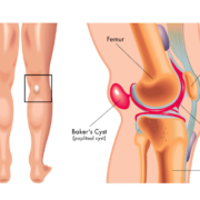 Kyste poplité (kyste de Baker) : découvrez les causes, symptômes, diagnostic et traitements possibles d’une grosseur derrière le genou.