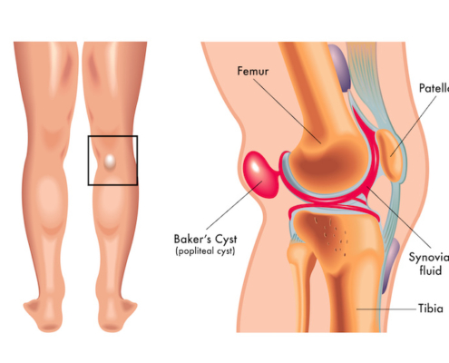 Kyste poplité (kyste de Baker) : découvrez les causes, symptômes, diagnostic et traitements possibles d’une grosseur derrière le genou.