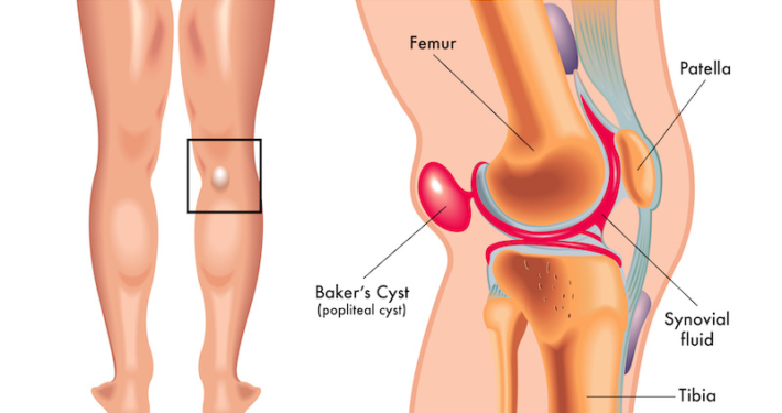 Kyste poplité (kyste de Baker) : découvrez les causes, symptômes, diagnostic et traitements possibles d’une grosseur derrière le genou.