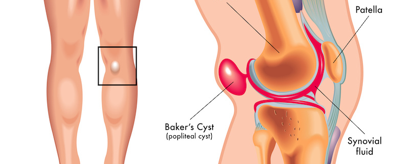 Kyste poplité (kyste de Baker) : découvrez les causes, symptômes, diagnostic et traitements possibles d’une grosseur derrière le genou.