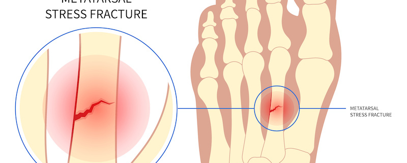 La fracture de fatigue est une microfissure de l'os lié à un surmenage.