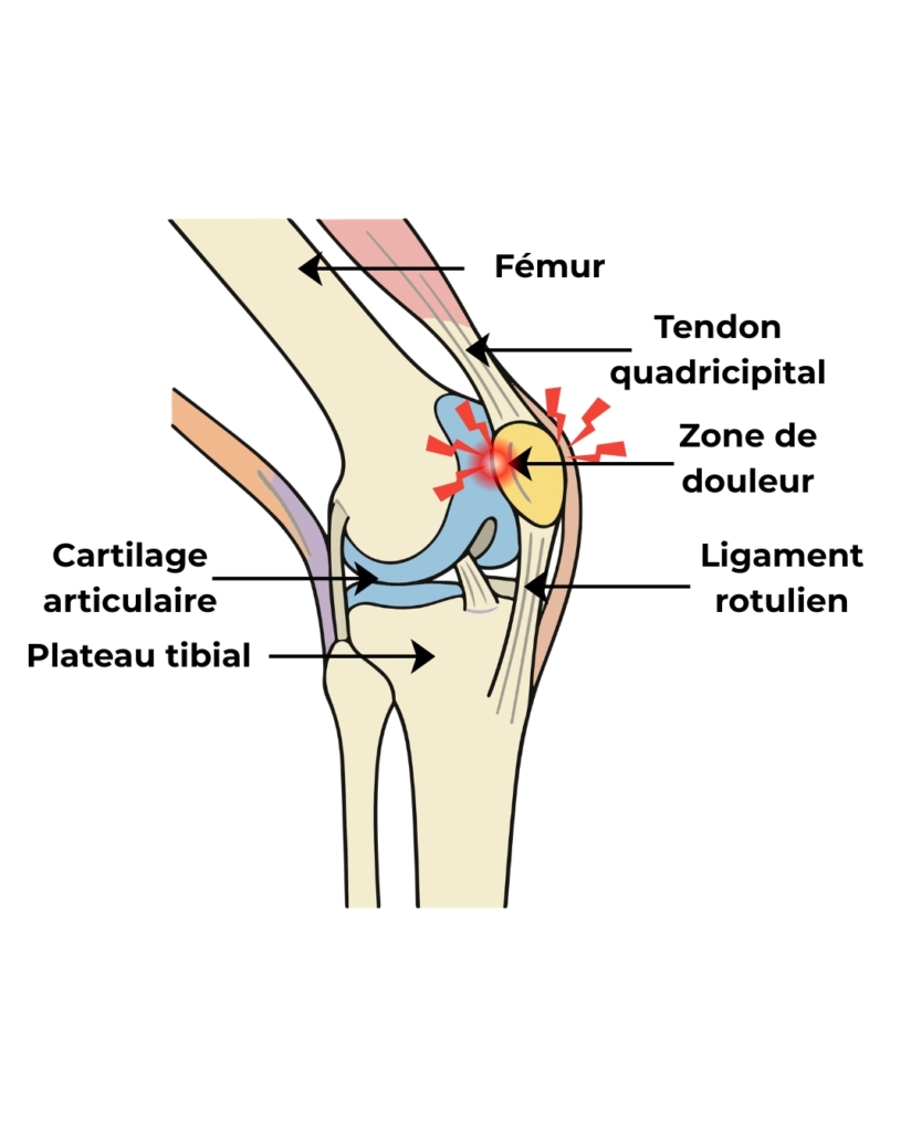 Le syndrome rotulien est l'une des principales douleurs du genou chez le coureur. Découvrez ses causes, ses symptômes, les traitements les plus efficaces et les conseils pour éviter les récidives.